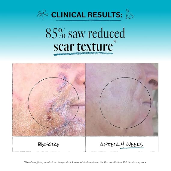 Derma E Scar Gel Scar Treatment for Face Hydrating Gel for Acne Scars, Burns & Stretch Marks with Panthenol & Allantoin, 2 oz