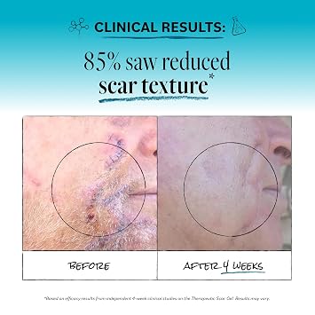 Derma E Scar Gel Scar Treatment for Face Hydrating Gel for Acne Scars, Burns & Stretch Marks with Panthenol & Allantoin, 2 oz