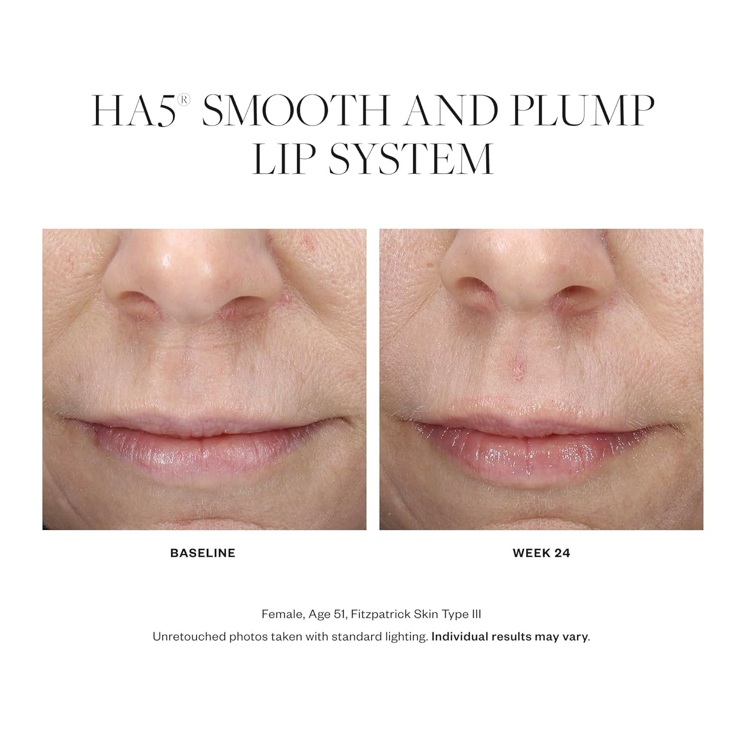 SkinMedica HA5 Smooth & Plump Lip System - Your Hydrating, Volumizing Lip Plumper for Visibly Fuller and Smoother Lips, 0.05 Oz