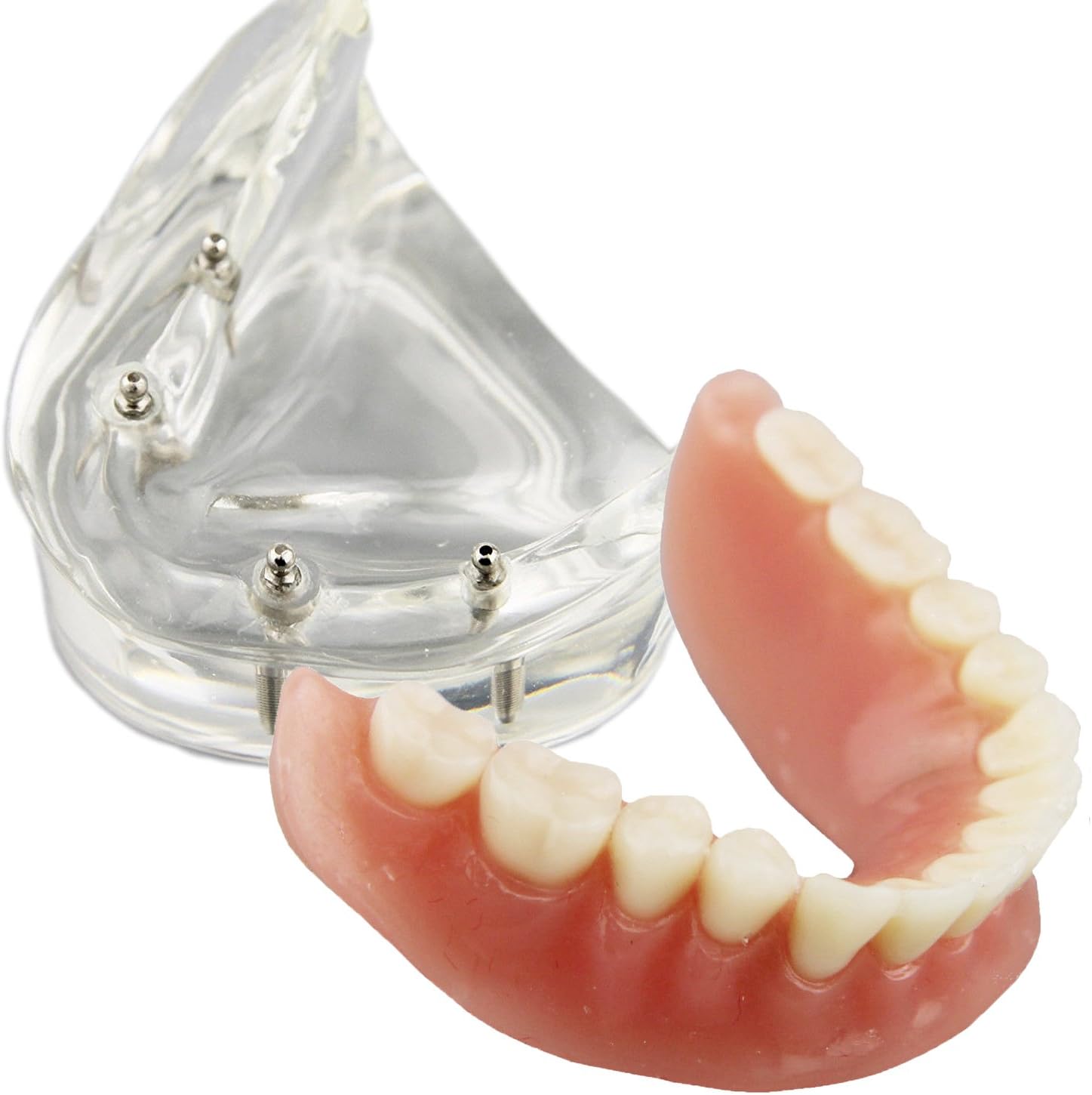 Dental Model Overdenture Inferior 4 Implants Demo for Teaching and Studying