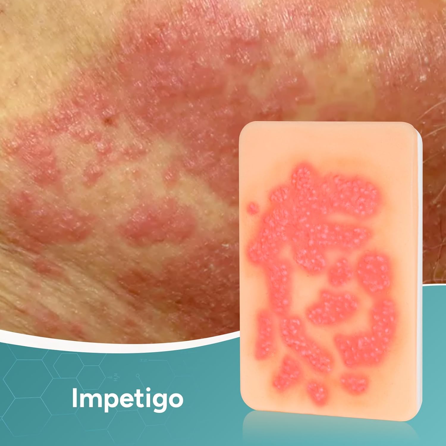 Wound Packing Trainer,Fungal Infection Wound Model, Palm Sized Wound Simulation Models for Medical Education, Wound Care Demonstrations Tool, 2PCS