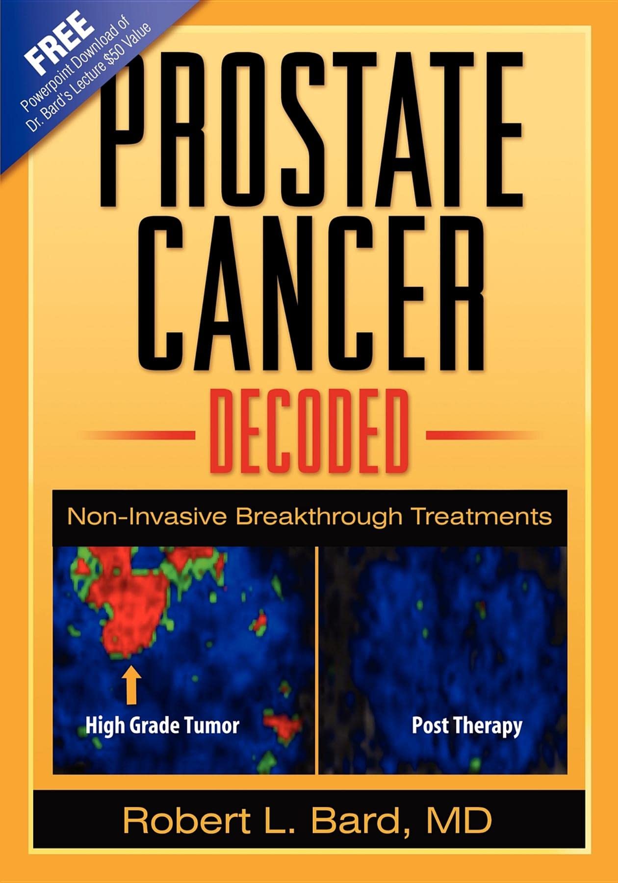 Prostate Cancer Decoded: Non-Invasive Breakthrough Treatments [Paperback] Bard, Robert L