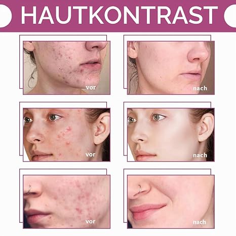 Aqua Peeling Solution AO3 Care Aqua facial lösungen Cleansing Serum Peeling-Lösung Hautpflege Dermabrasion Gesichtsreinigungsserum für Hautpflege Schönheitsmaschine