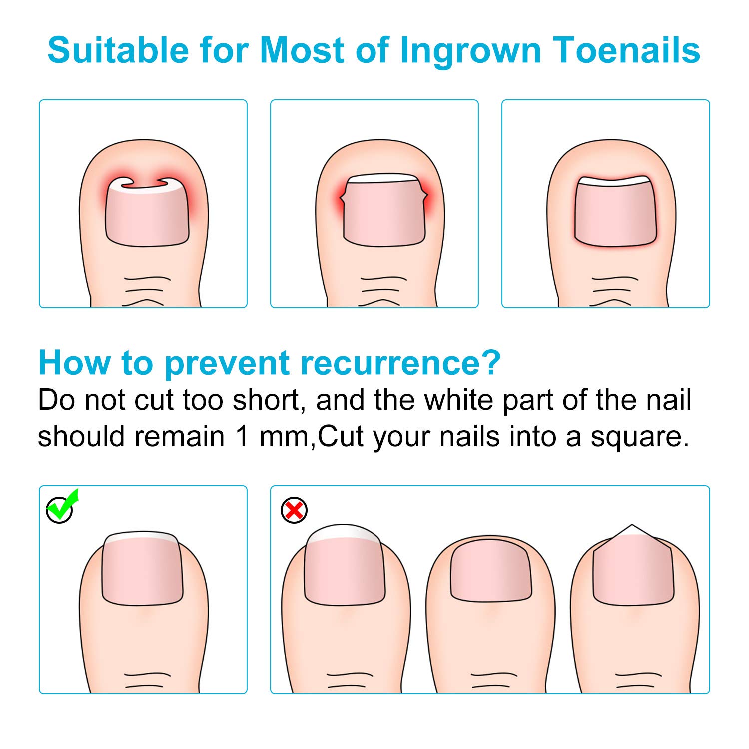 10 Pieces S Size Ingrown Toenail Tools Include Ingrown Toenail Lifter Buckle File Cuticle Pusher Sticker Stainless Steel Foot Care Tool : Beauty & Personal Care