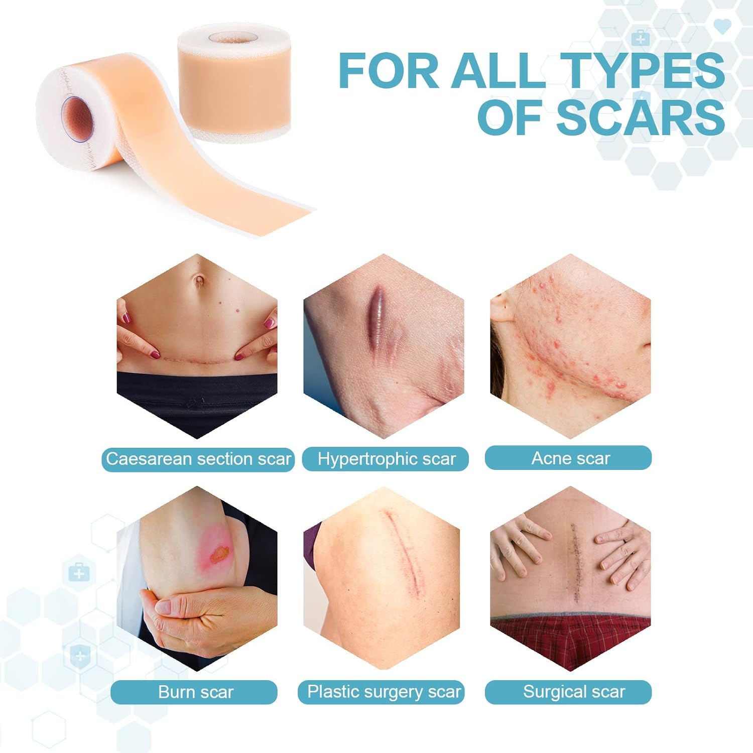 JOICE IMPEX Silicone Scar Sheets (1.6”x60”Roll-1.5M), Silicone Scar Tape, Reusable Scar Removal Sheets for C-Section, Surgery, Burn, Keloid, Acne 4