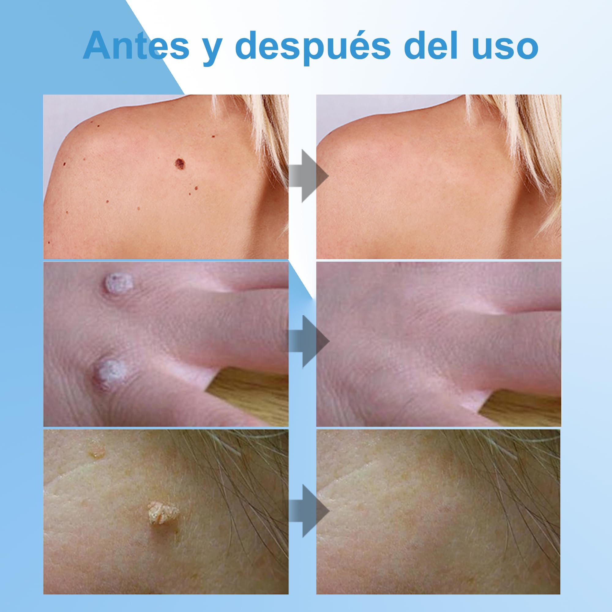 Crema para eliminar verrugas y acrocordones, kit para rostro y cuerpo, eliminación suave de verrugas plantares, comunes, callos y planas, 20 g - 5