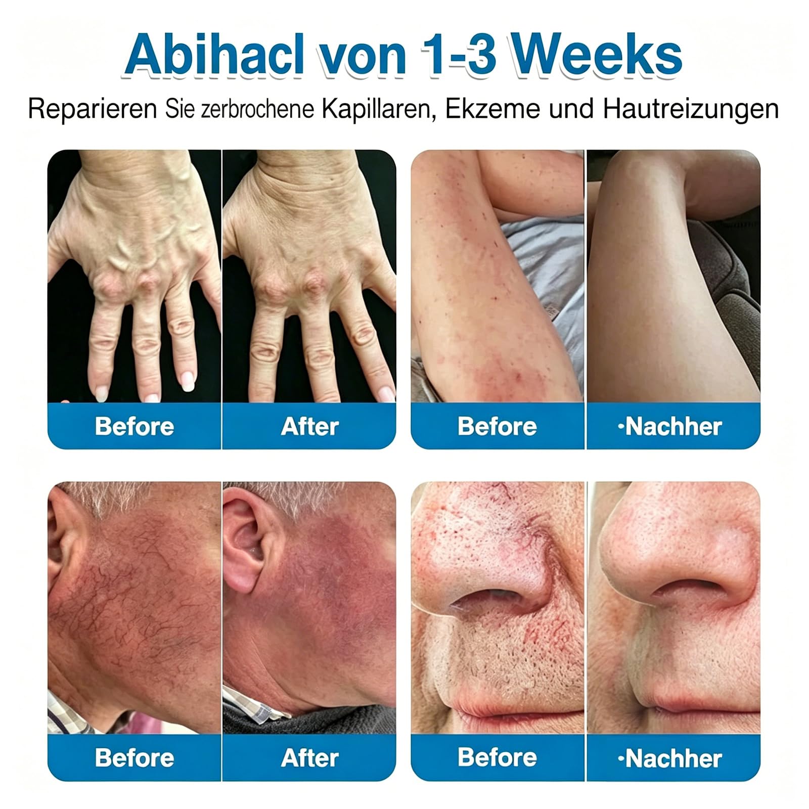 GFOUK VeinRepair Mikronadel Pflasterrolle, GFOUK Mikronadel Pflaster, Professional Vein Heal Pflaster für alle Hauttypen (2PCS)