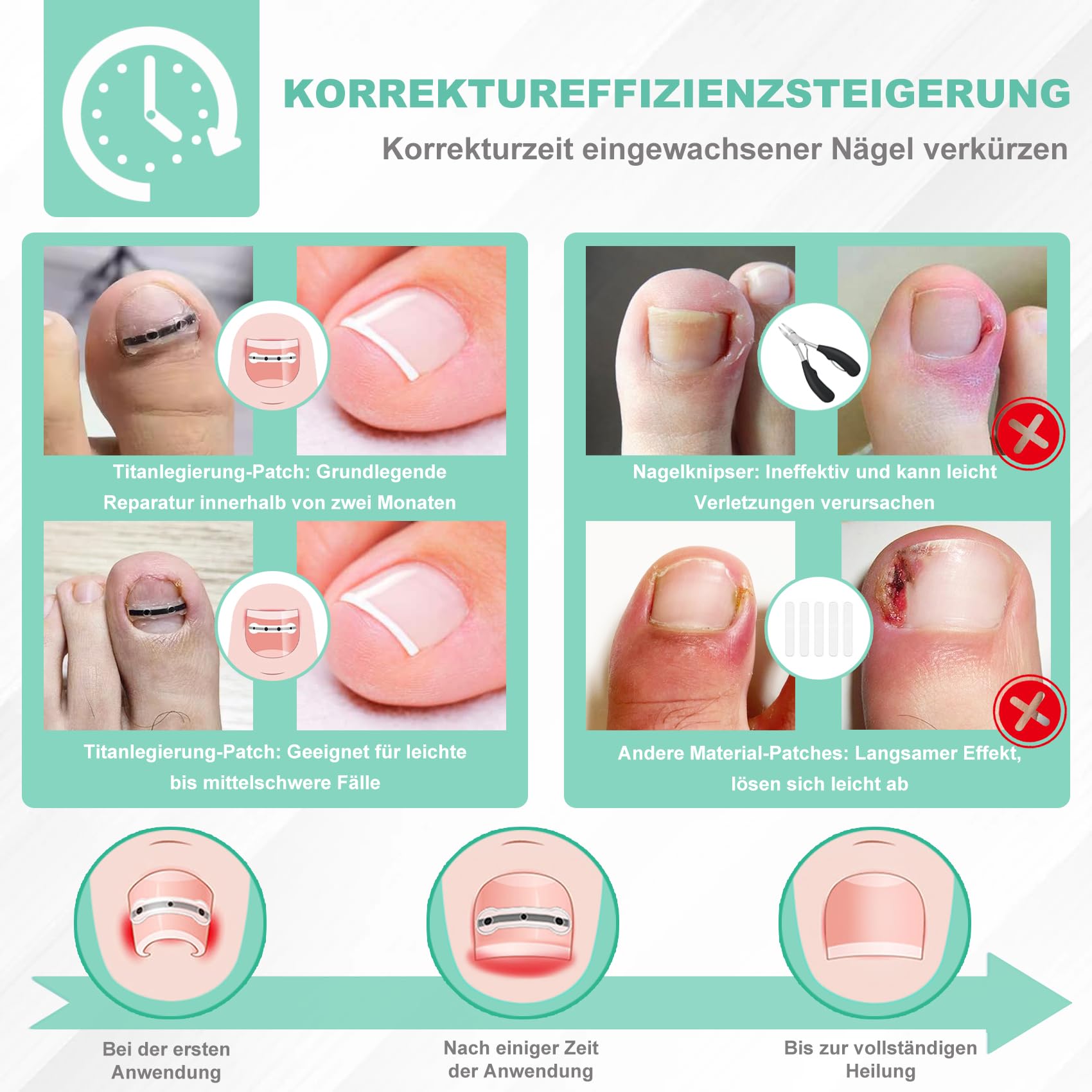 Eingewachsene Zehennägel Set Zehennagel Korrektur Patch 9pcs Nagelspange Fußnägel Zehennagelheber Werkzeugset für Paronychie Zehennagel Eingewachsen Reparatur, 0.59/0.67/0.79in