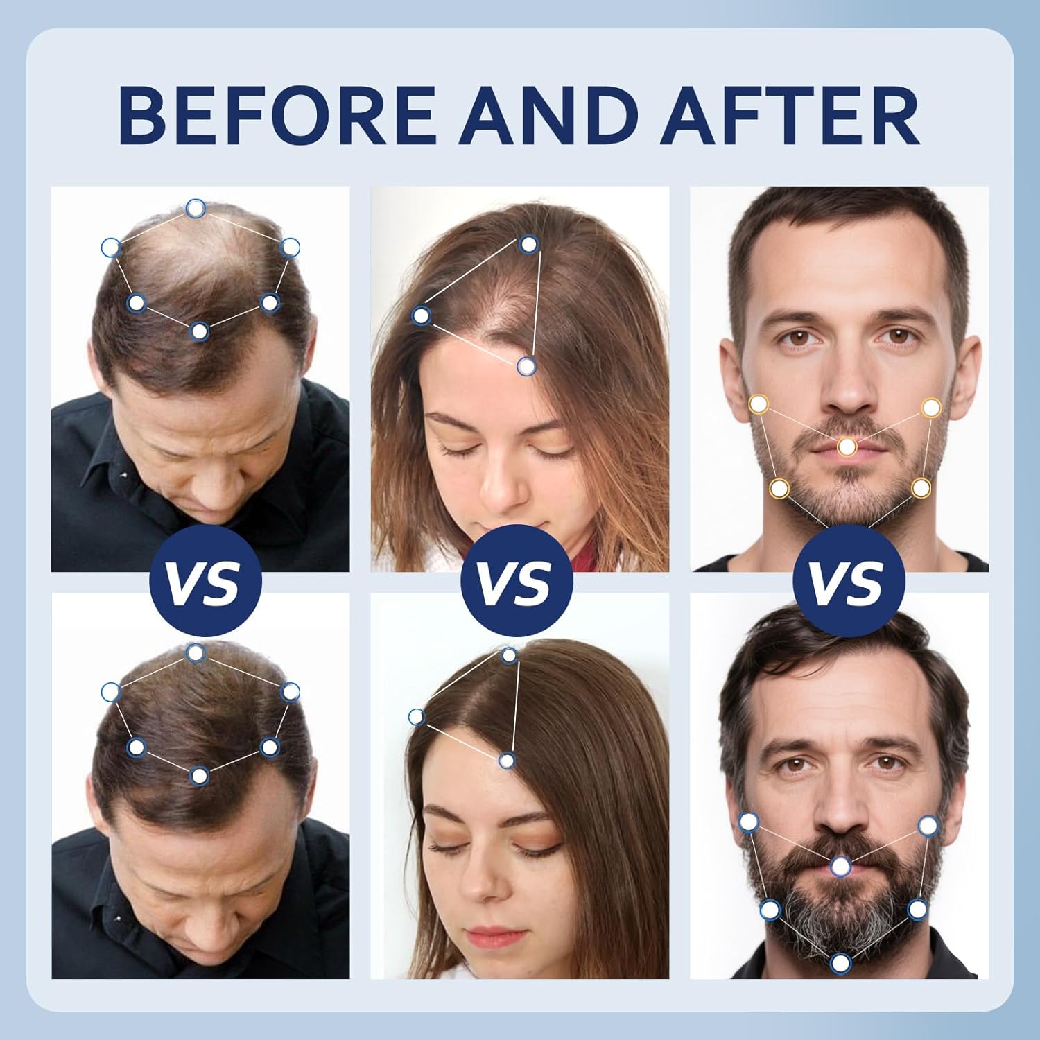 5% Minoxidil Hair Growth Serum for Men & Women with Biotin: Minoxidil for Men and Women, 5 Percent, Hair Regrowth Treatment, Extra Strength (6 FL OZ, Dropper 3pcs) - Image 4