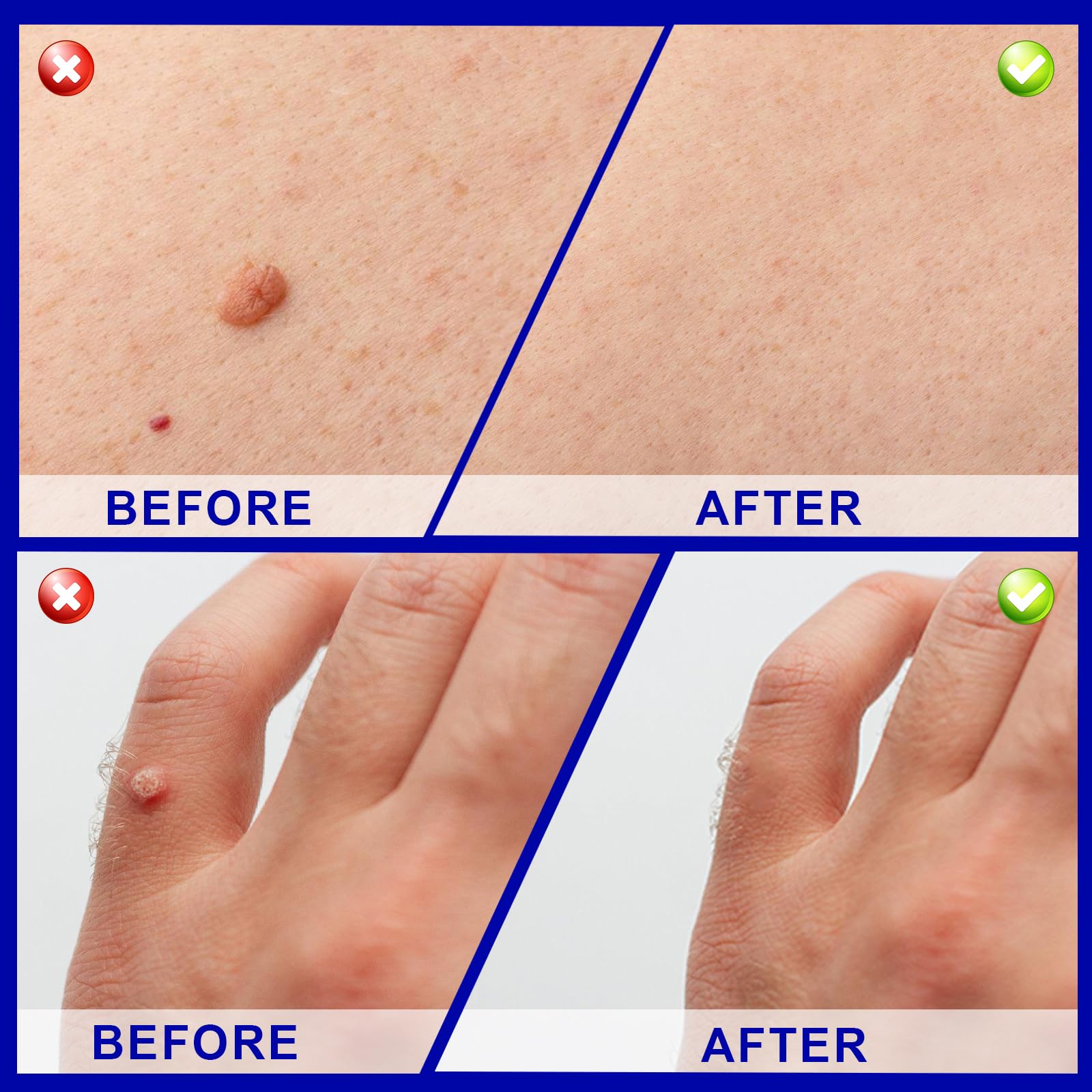 30ml Skin Tag Remover, Suavemente Las Verrugas Quitar Comunes, Mayoría de las Partes del Cuerpo, Fácil de Usar, Fórmula Suave
