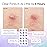 grace & stella Award Winning Pimple Patches for Face - Dermatologist Tested Acne Patches - Hydrocolloid Patch for Breakouts, Whiteheads - Vegan Acne Spot Treatment for Face (Multishape, 216 Count)
