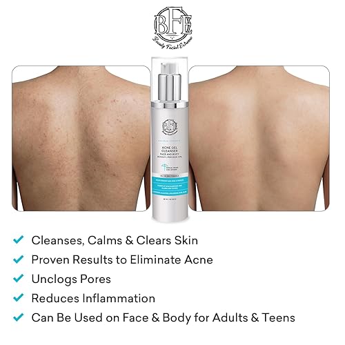 Miniatura 6 de Tratamiento de lavado facial para acné con peróxido de benzoilo al 10% - Combate las imperfecciones del acné al contacto para brotes quísticos, piel