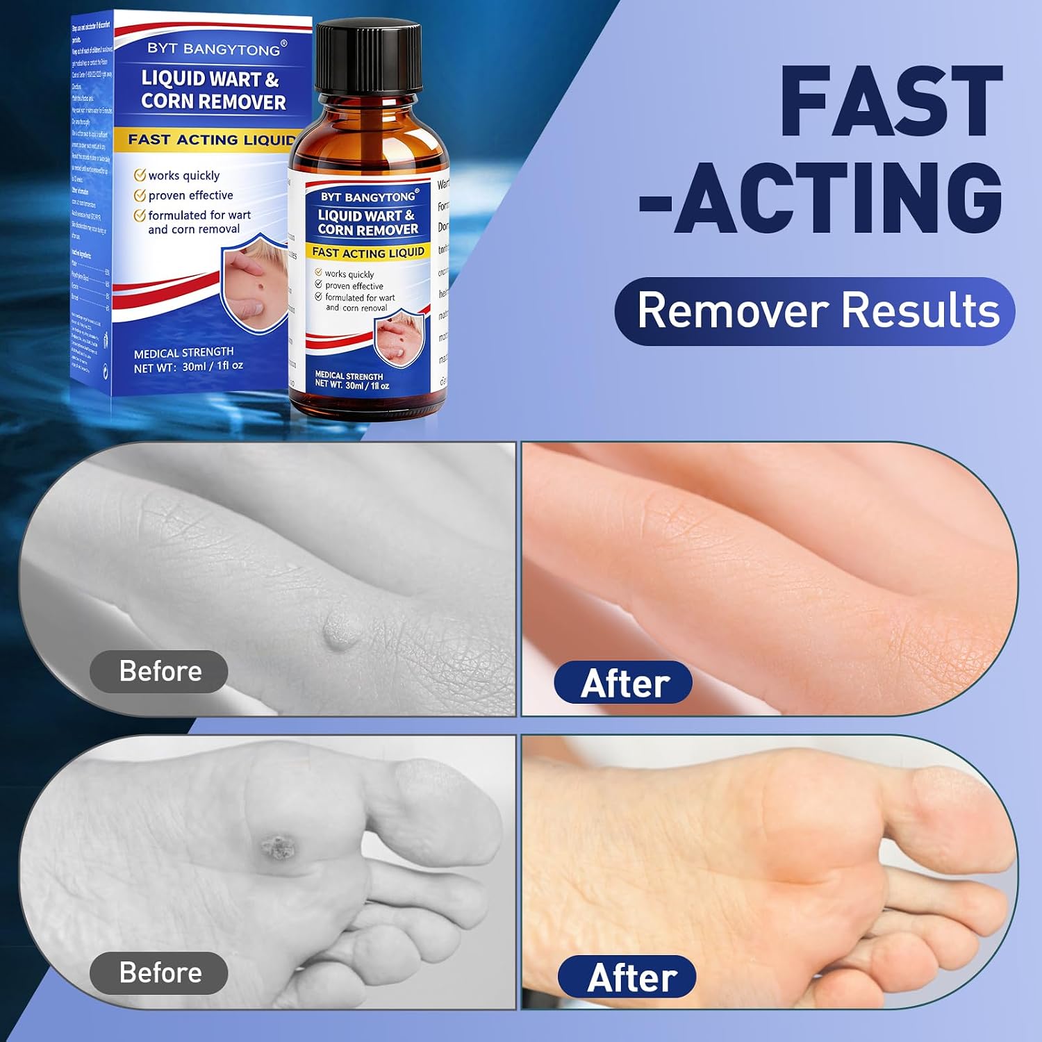 Wart Remover Liquid - Gentle Formula for Plantar Warts, Common & Corn on Feet, Hands and Other External Areas - 17% Salicylic Acid - NET WT: 30ml/ 1fl oz