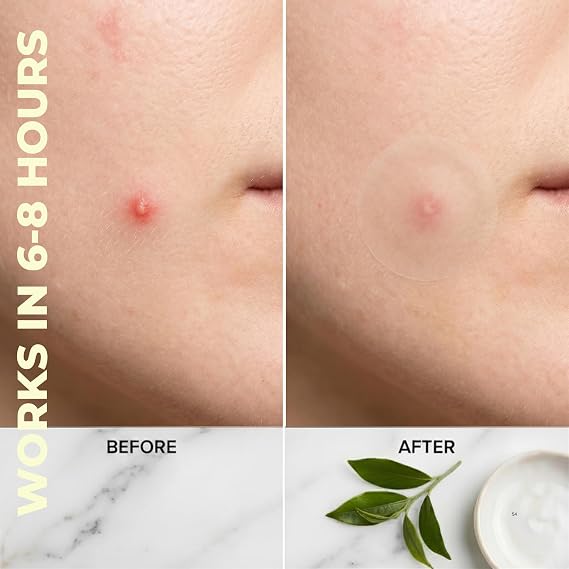 Miracle Patch Hydrocolloid Acne Pimple Patches (96 Count) - Tea Tree Oil & Salicylic Acid Infused Zit Stickers - Matte Clear Invisible Face Blemish Spot Cover, 3 Sizes Variety Pack