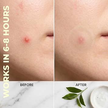 Miracle Patch Hydrocolloid Acne Pimple Patches (96 Count) - Tea Tree Oil & Salicylic Acid Infused Zit Stickers - Matte Clear Invisible Face Blemish Spot Cover, 3 Sizes Variety Pack