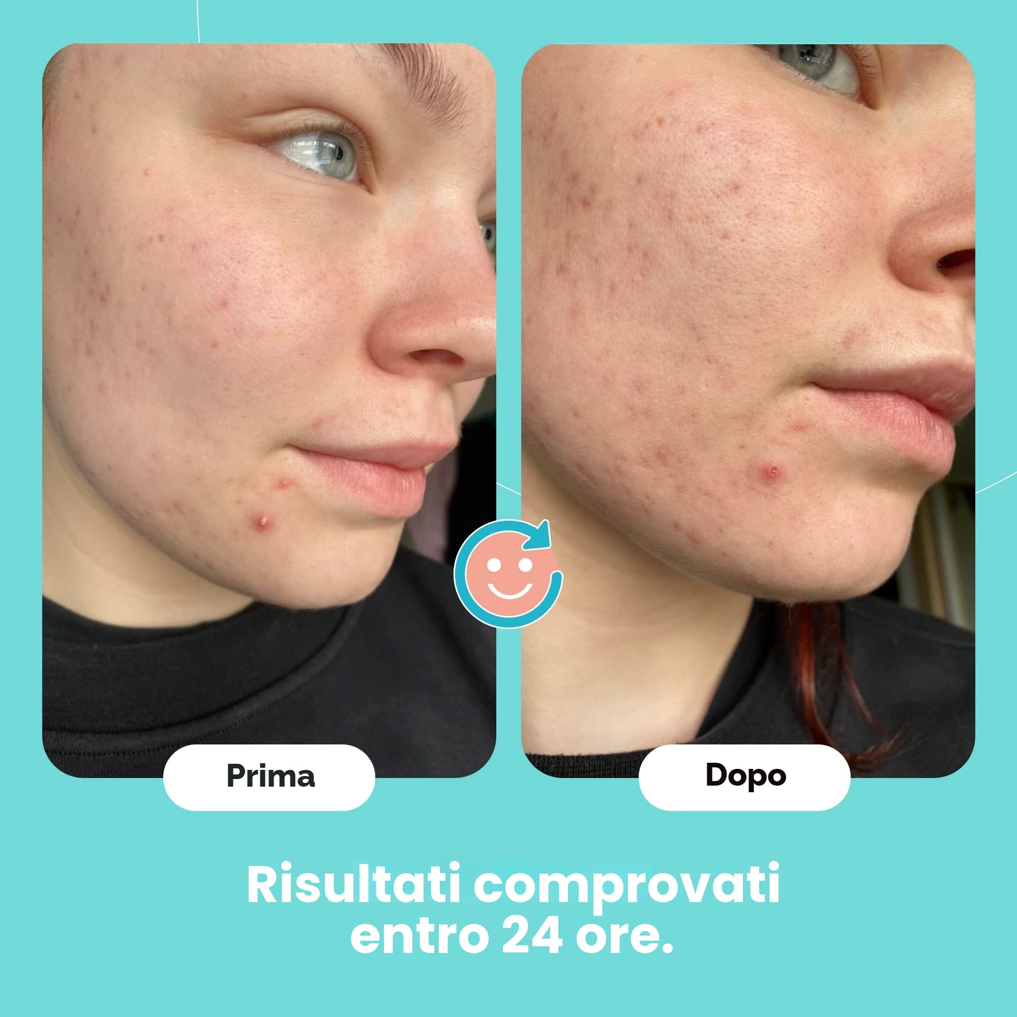 SKIN CHOICE Patch Brufoli – Breakout Pimple Patch Classic – Idrocolloidali Invisibili Cerotti Brufoli Viso, Vegano, Non Testato Sugli Animali, Cura Della Pelle Coreana (75 Cerotti)