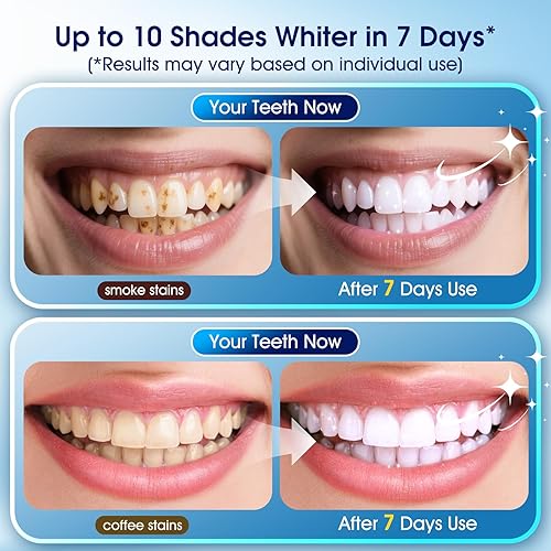 Teeth Whitening Kit — top-down angle highlighting key features