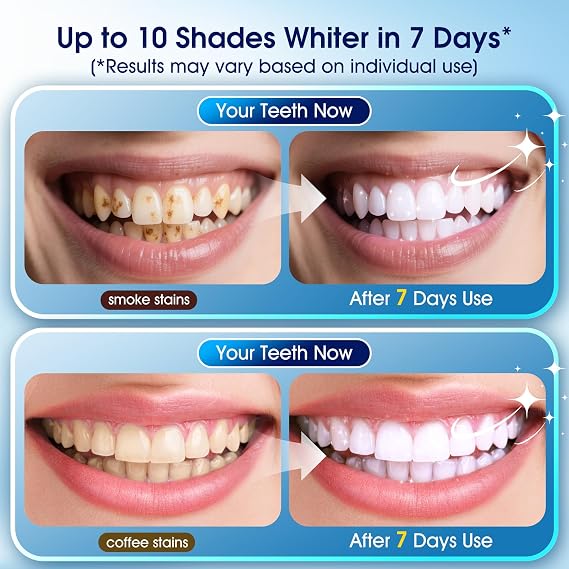 Teeth Whitening Kit with LED Light 1 Whitening Gel Pens + 1 Desensitizing Pens 35% Carbamide Peroxide Whiten Teeth in 7 Days Safe for Sensitive Teeth & Enamel,0.28 Fl Oz (Yuzu)