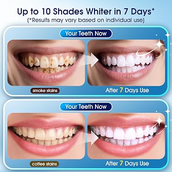 Teeth Whitening Kit with LED Light 1 Whitening Gel Pens + 1 Desensitizing Pens 35% Carbamide Peroxide Whiten Teeth in 7 Days Safe for Sensitive Teeth & Enamel,0.28 Fl Oz (Yuzu)