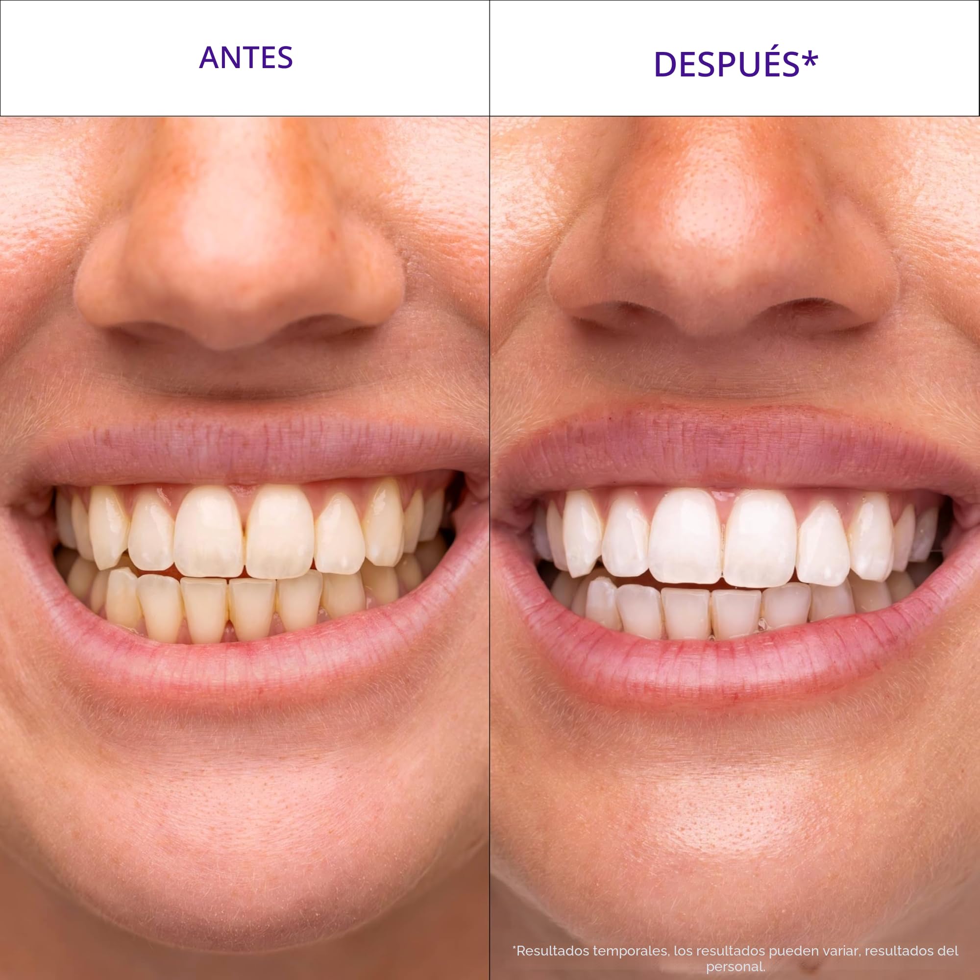 Hismile V34 Tiras blanqueadoras, blanqueamiento dental, blanqueamiento dental morado, tratamiento de manchas dentales, 14 unidades (paquete de 14)