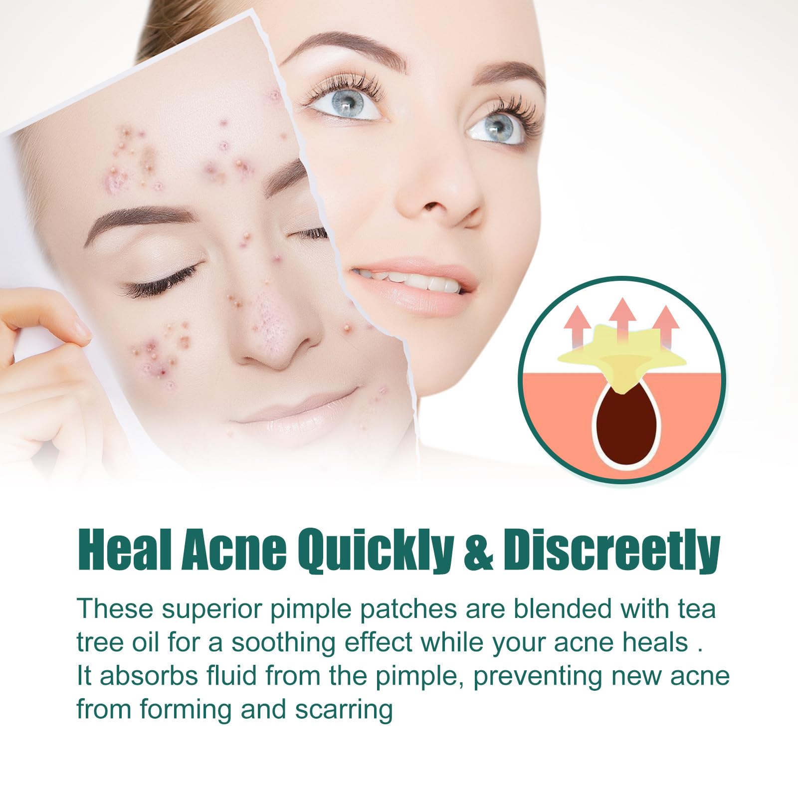2 Acne Patch Star, Tea Tree Oil Spot Sticker, Water Colloidal Patch for Acne Flaws, and Facial Acne (112 dots, 8mm and 12mm) - Image 4