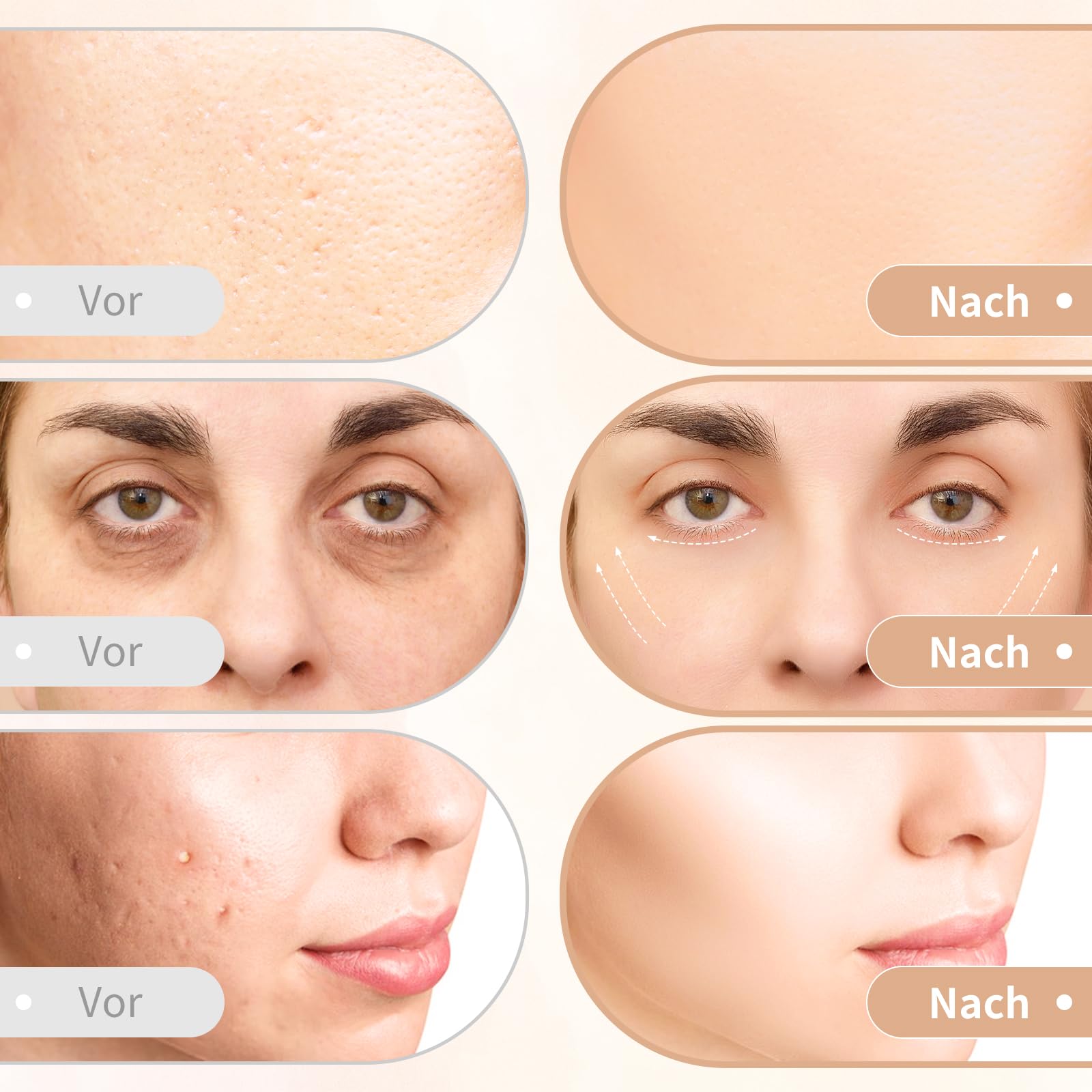 CARER BEAUTY Gesichtsmassagegerät Gegen Falten 5 in 1 Radiofrequenz Gerät Gesicht mit 2 LED Lichttherapie RF Vibration Ion für Anti Falten&Aging Akne Entferne Gesichtpflege Tiefenreinigung