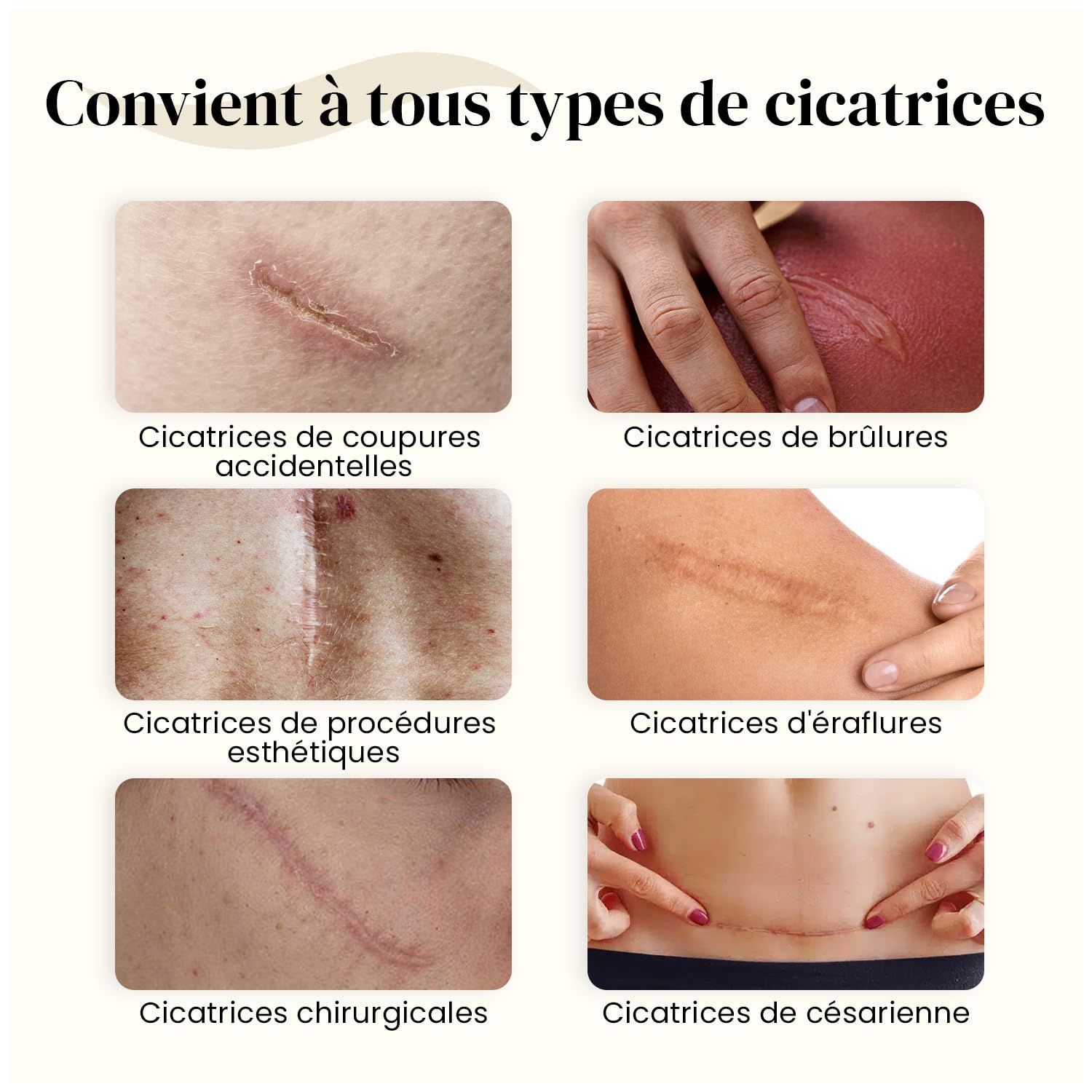 DERMATIX - Traitement et prévention des cicatrices - Chirurgie, brûlure - Gel de silicone - Tube de 15 grammes