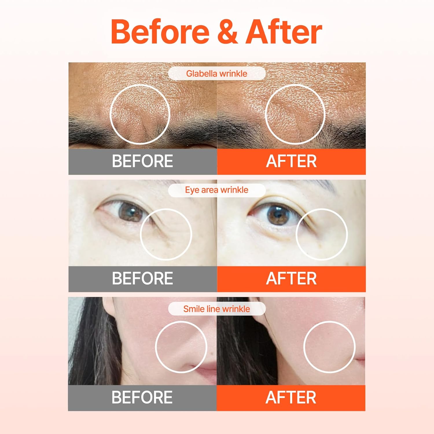 Wrinkle Patches ACROPASS RETI-RN Microcone, Deep Wrinkle, PDRN 10,000 ppm, Retinol 3,300 IU/g, Hyaluronic Acid, Anti-Aging (Slim Type, 6 Count) - Image 5