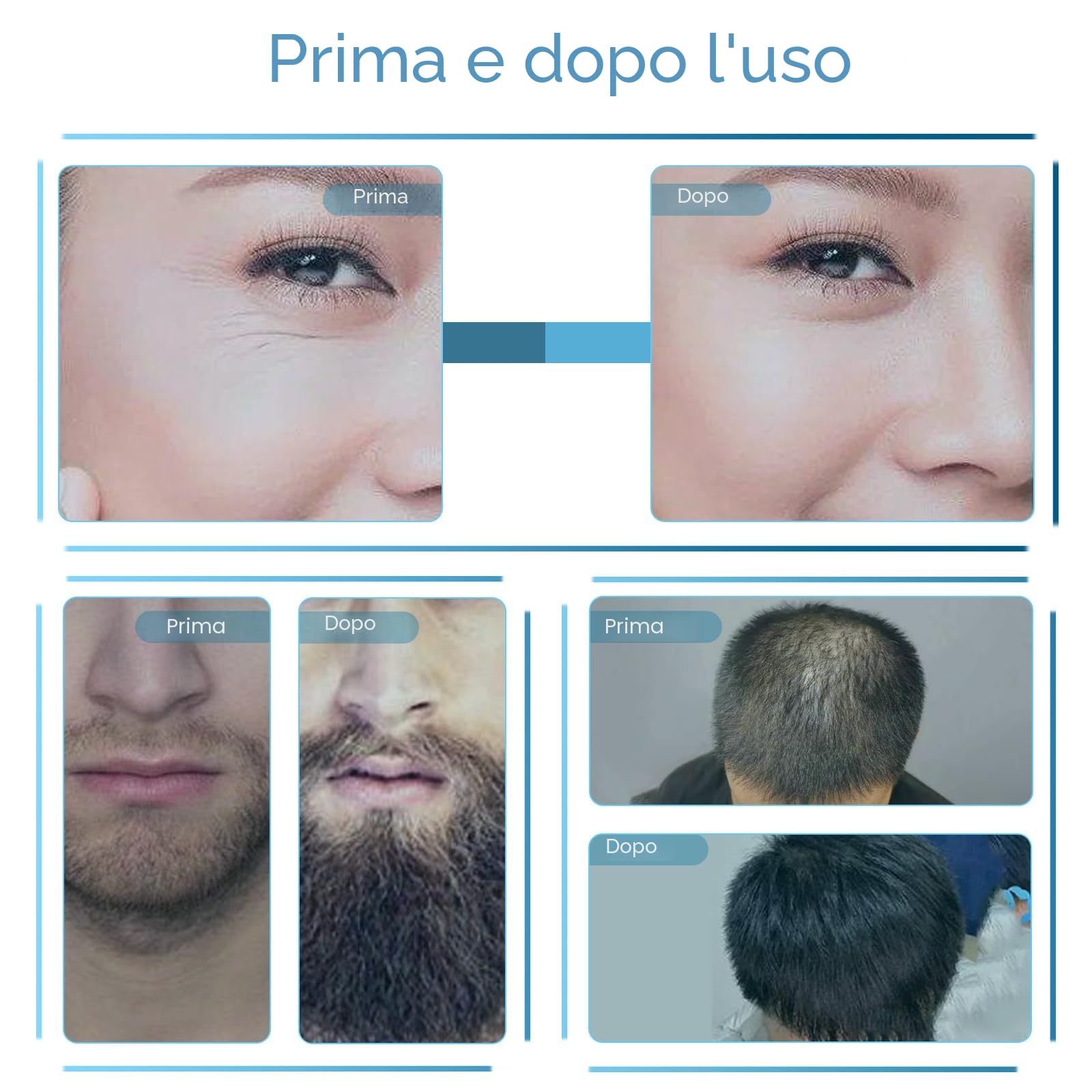 Derma Stamp, Dermastamp Regolabile 0-3 mm, Derma Roller Capelli, 140 Perni, Timbro Professionale Microneedling Stamp per Stimolare la Crescita di Capelli, Barba, Viso