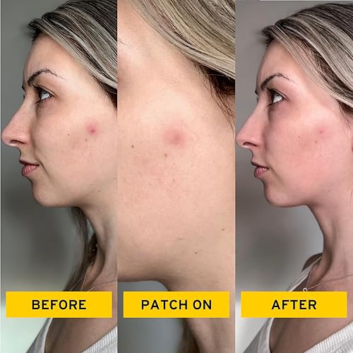 Miniatura 2 de No hay cosas malas parches curativos para el acné con hidrocoloide, impermeables, parches invisibles para espinillas, para usar debajo del