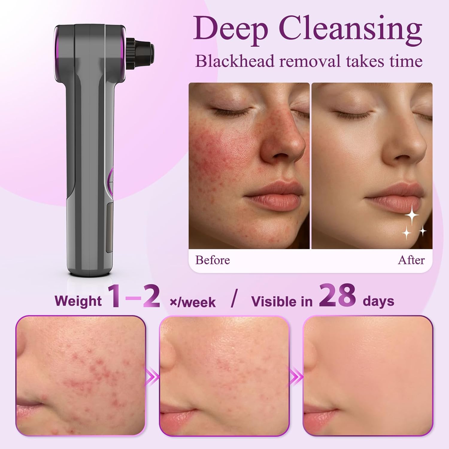 Blackhead Remover Vacuum, Pore Vacuum Blackhead Extractor, Pore Suction Face Suction, Electric 5 Heads Heating, Nose & Face Deep Clean, Pimple Sucker Remover Tools, USB Rechargeable 9 Modes 3 Levels - Image 6