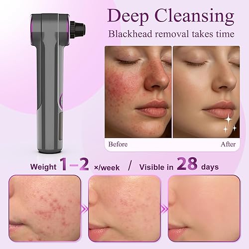 Miniatura 6 de Removedores de vacío de puntos negros, limpiador de succión de poros con calefacción, 3 niveles de succión ajustables y 9 modos, kit extractor de