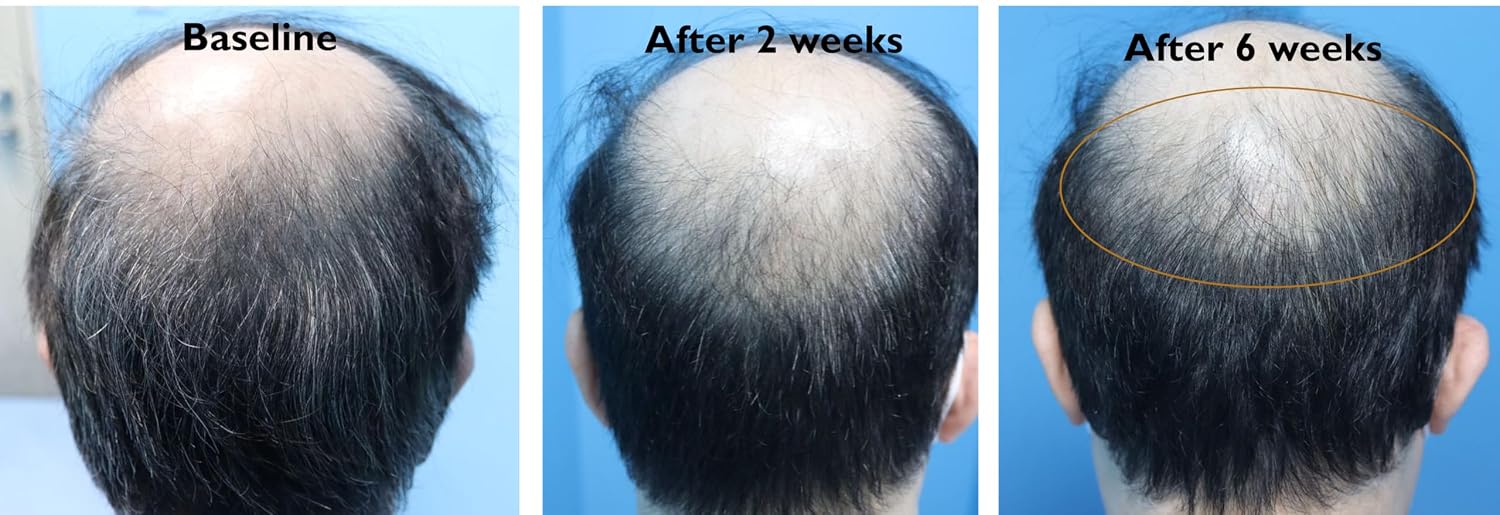 RHX Advanced Follicle Activator for Men – Hair Serum for Thinning Hair – PEPTIDE SCALP SYSTEM Advanced EGF + TGF peptide complex designed to support fuller, healthier-looking hair