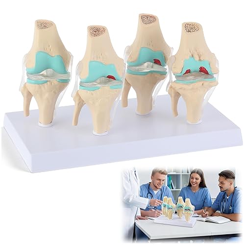 4 Stage Knee Model Human Lumbar Spine Osteoarthritis Joint Anatomical