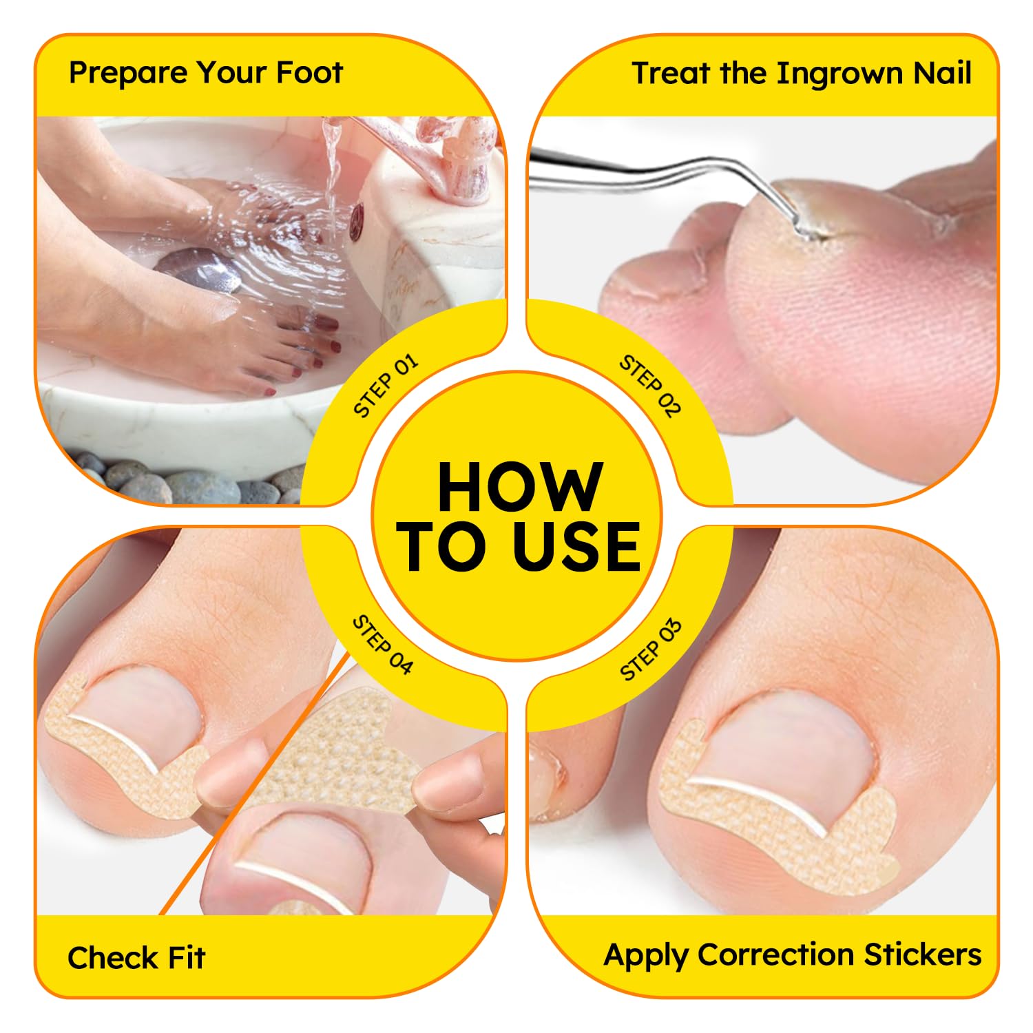 Ingrown Toenail Treatment, Breathable Curved Toenail Corrector，Ingrown Toenail Corrector Strips with File and Lifter, Nail Correction Stickers Removal Kit Pain Relief 60Pcs