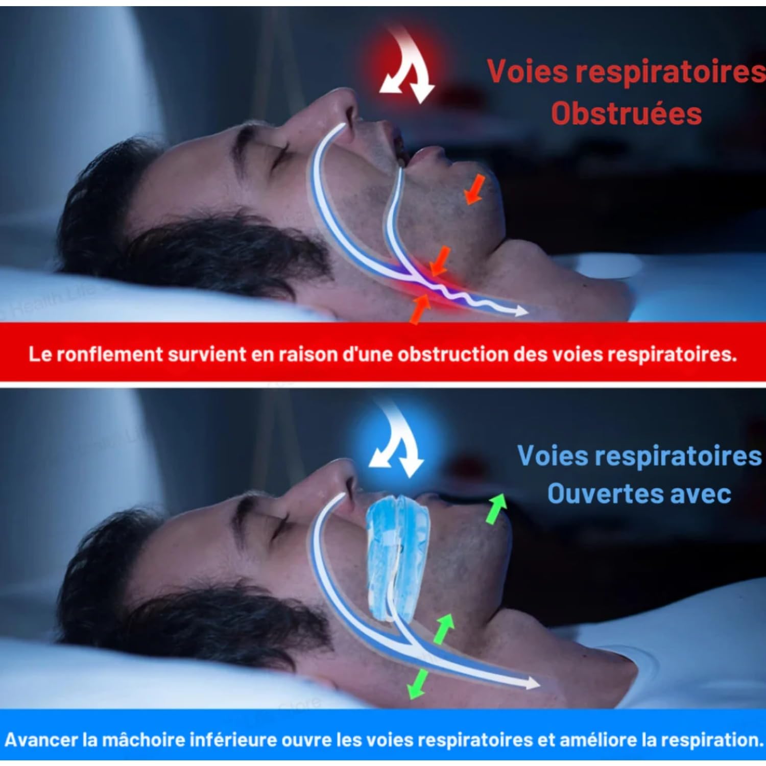 Protège-dents Anti-ronflement - Ajustement Confortable, Pratique à Transporter
