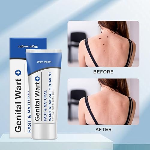 Miniatura 6 de Gel de verrugas en crema de acción rápida de máxima resistencia, congelación de acción rápida, crema para verrugas genitales fácil de transportar (1