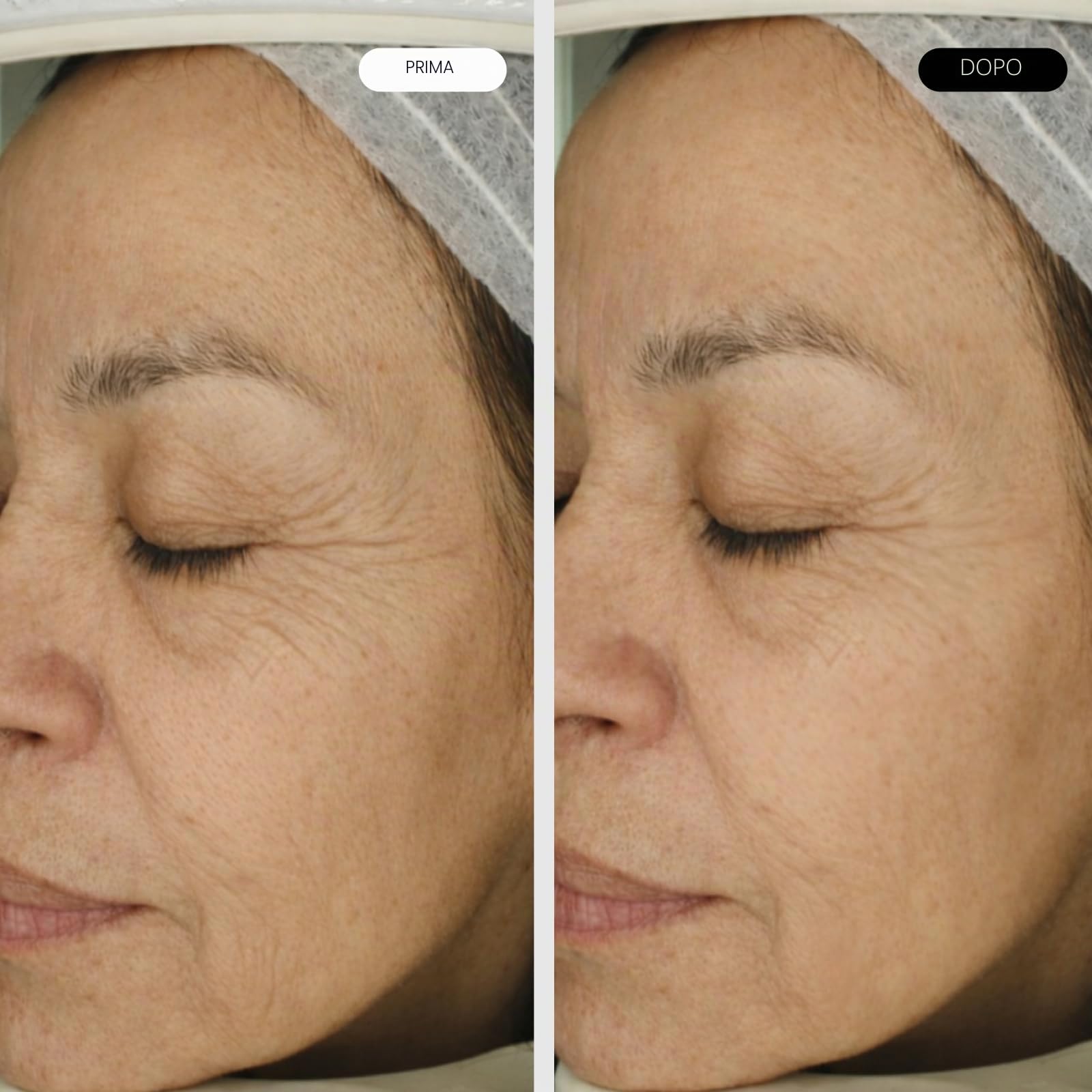 CLINICAL BEAUTY FILLER – Trattamento Anti-Rughe – 1 Applicazione – Tecnologia Avanzata – Contrasta il Rilassamento Cutaneo – Facile, Indolore e Sicuro – Con Acido Ialuronico e Peptidi