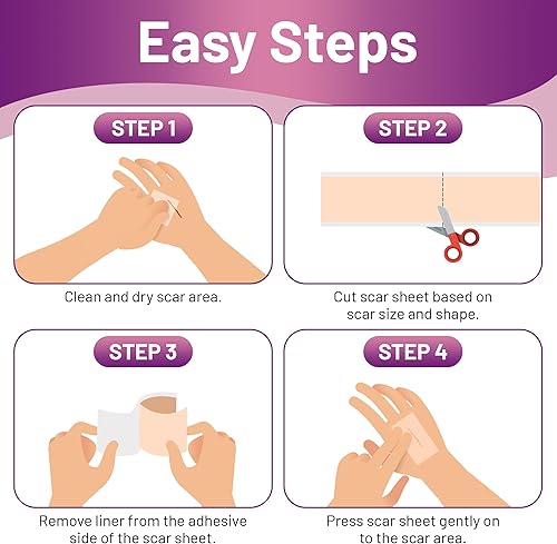 Miniatura 6 de ChicDerma Cinta de silicona para cicatrices de 1.6 x 120 pulgadas, hojas de silicona para cicatrices quirúrgicas, tiras de silicona suave de grado