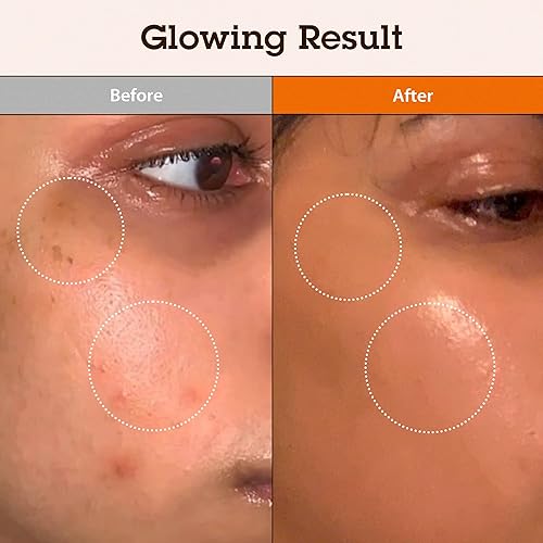 Miniatura 2 de BLITHE Niacinamida 5% + ácido tranexámico 3% de suero, corrector de manchas oscuras  Vitamina B3 niacinamida para cara, calma la piel Cica y