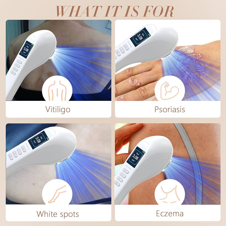 iKeener 308nm Narrow Band UVB Phototherapy Lamp