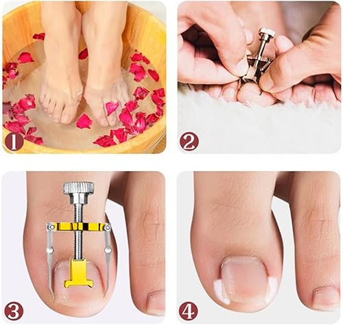 Miniatura 7 de Cortador de uñas encarnadas, cortador de uñas, cuchillo de pedicura para uñas gruesas, tratamiento de corrección de uñas de los pies, cuchillo de