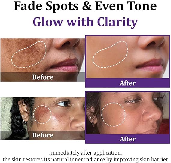 Epiglow Melanex Advanced Cream, 20g Epiglow Melanex Anti Hyperpigmentation Cream, Melasmas Hyperpigmentation Treatments for Face, Antiaging Pigmentation Face Dark Spots Creams, for All Skin Types