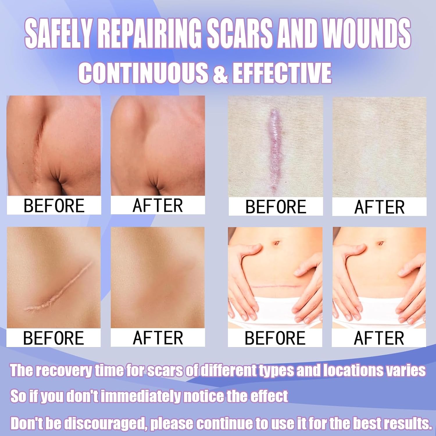 FODIEME Silicone Scar Sheets, Premium Hypoallergenic Treatment for New and Old Scars, 6 Weeks (1.5M, Count, 1) - Image 6