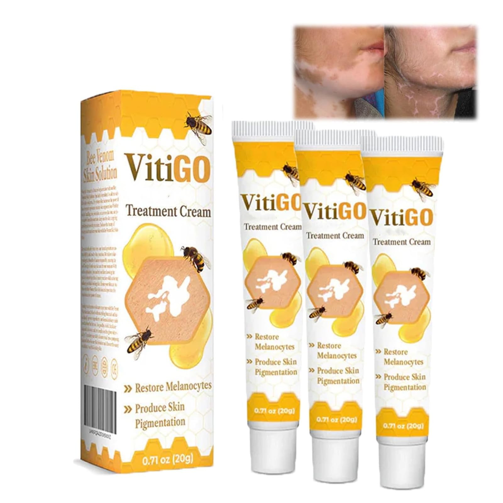 Fivfivgo Vitiligo Apisin TREAtment Cream,VITIligo TreatMENT Creams,Vitiligo Cream, Apisin VitILIgo TreATment CREAm For All Skin Types,Suitable for all skin types