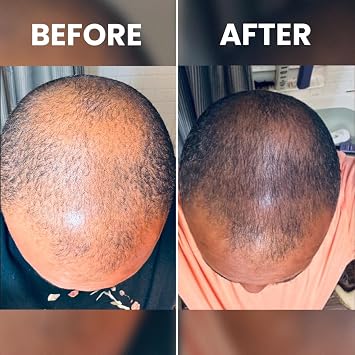 Rennora Hair Growth Serum with Peppermint, Nettle & Rosemary Oil (1 Pack)