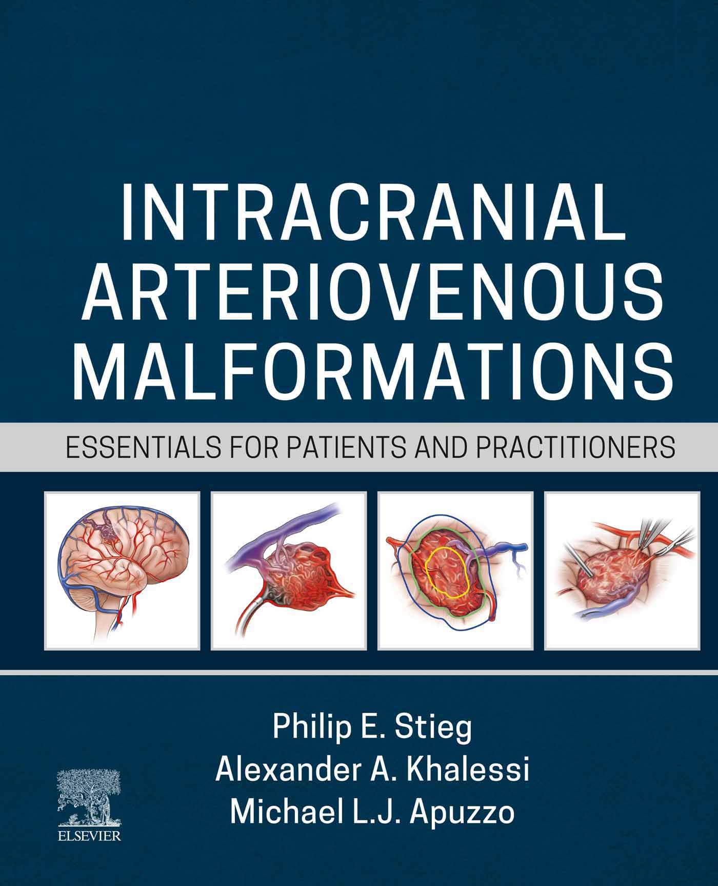Intracranial Arteriovenous Malformations - E-Book: Essentials for Patients and Practitioners