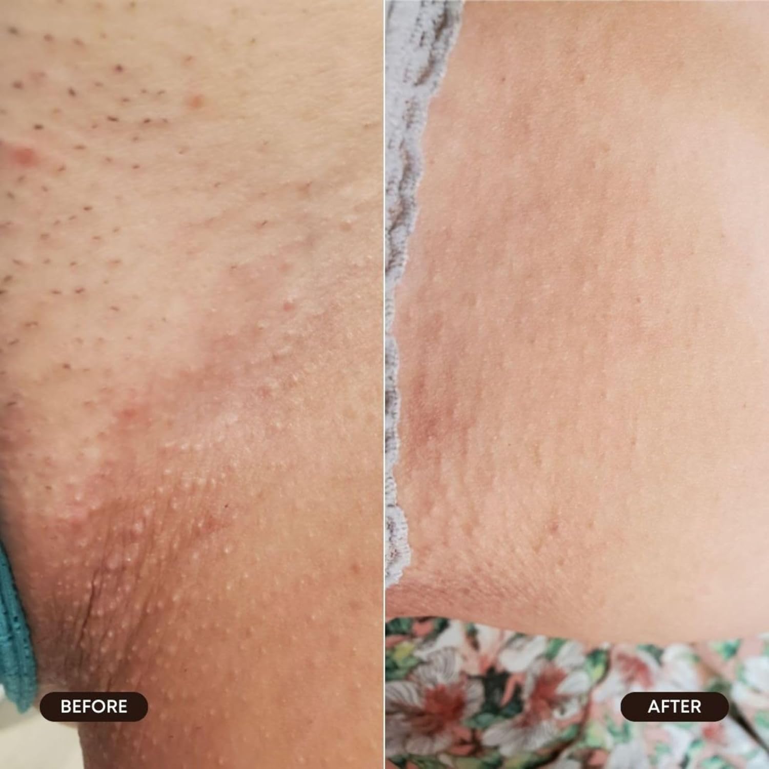 Bushbalm Roller Rescue Ingrown Hair Serum, Includes AHA and BHA - Exfoliating, Soothing, Cooling for Intimate Areas, Underarms - Helps With Razor Bumps and Ingrown Hairs, Blue 50 ml - Image 6