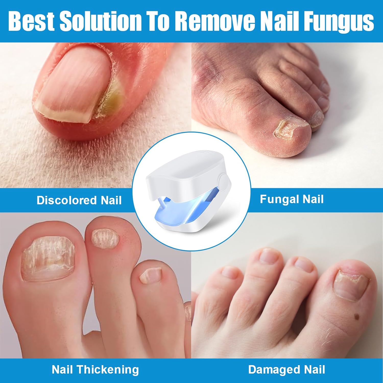 Nail Fungus Laser Treatments Device, Nail Therapy for Onychomycosis