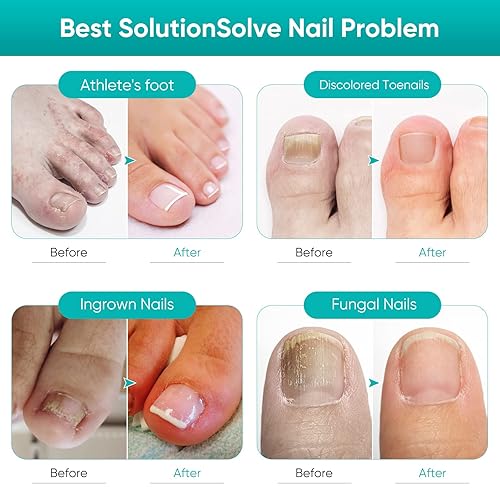 Miniatura 5 de iTecFreely Toenail Fungûs Treatment, Nail Repair Solution for Damaged Nails and Discolored, Effectively Restoring Healthy Nail Repair for